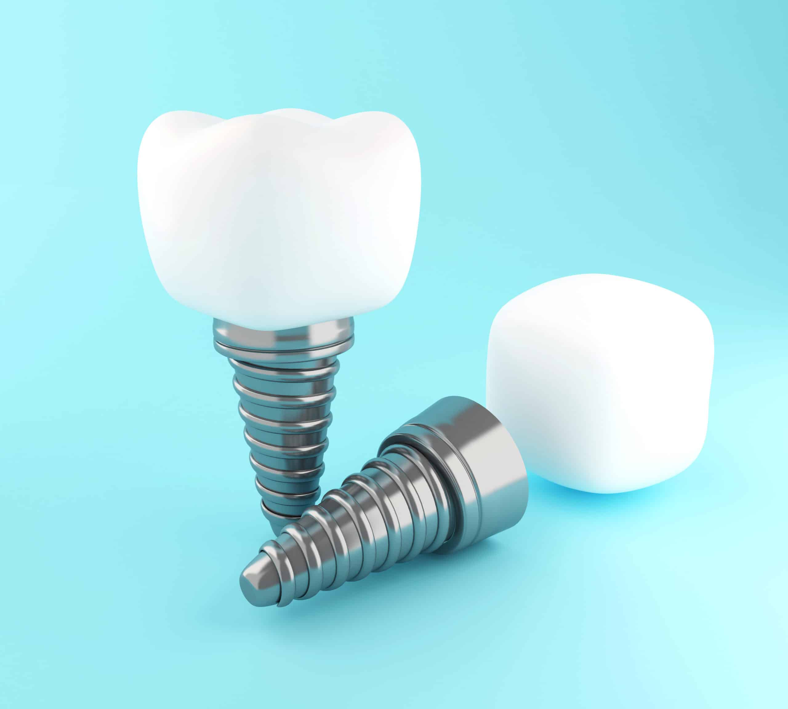 Custom Vs Stock Abutments Vertrue Dental Lab Custom Vs Stock Abutments Vertrue Dental Lab